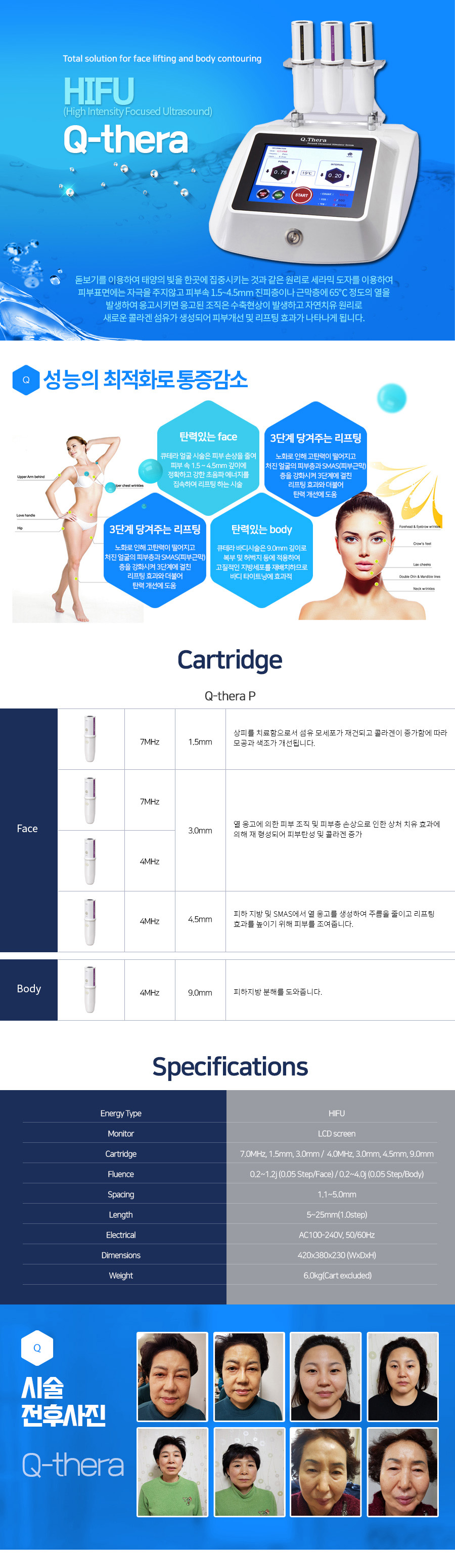 HIFU 큐테라